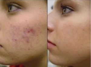 Badyaga pentru fața de pe acnee și pete de vârstă - înainte și după fotografii