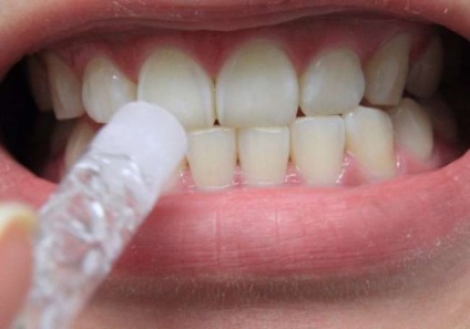 Fehér foltok a fogakon - a megjelenés okai és a kezelés módjai
