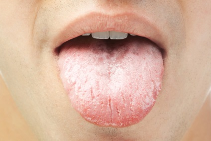 Бели петна по езика на възрастни причини, диагноза и лечение