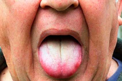 Acoperire albă pe cauze, diagnostice și tratament al limbii adulte