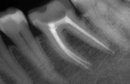 Durerea dintelui după îndepărtarea nervului - maestru