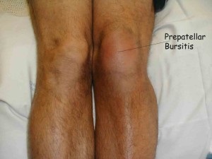 Bursită articulație genunchi - 5 metode de tratament a genunchiului bursită