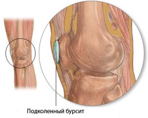 Bursitis térdízület - 5 módszer a bursitis térdének kezelésére