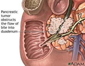 C) endoproteticele ductului biliare (bugie și stenting) - stadopedia