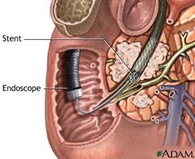 C) endoproteticele ductului biliare (bugie și stenting) - stadopedia