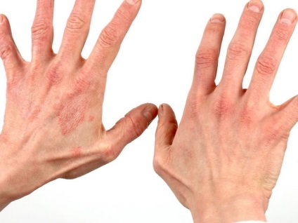 Mint a dermatitis kezelése fegyvereken vagy kézen