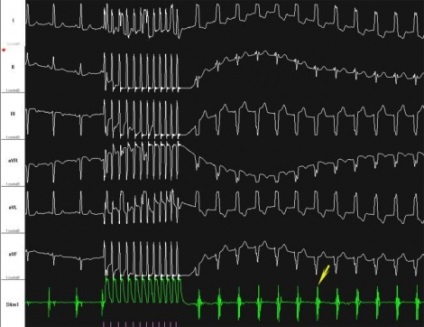 Diagnosticul transesofagian de electrocardiostimulare, simptomele de aritmie și tratamentul în Belarus