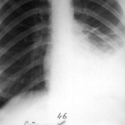 Tuberculoza pulmonară cirotică - bisturiu - informație medicală și portal educațional