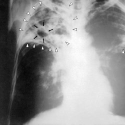 Tuberculoza pulmonară cirotică - bisturiu - informație medicală și portal educațional