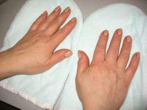 Dermatitis a kezelés, tünetek, megelőzés kezében