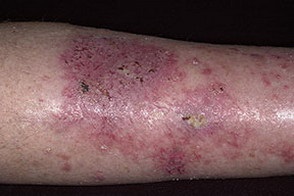Dermatita a picioarelor - și cum să facem față cu ea