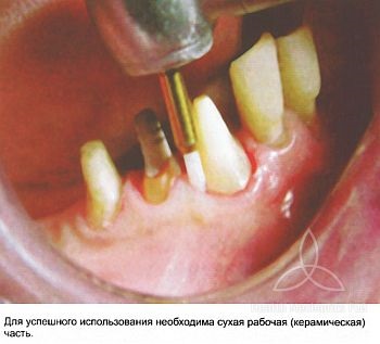 Tăietor de țesut Dia-tessin (tundere de țesut), metoda btdentall-dentistry accessible