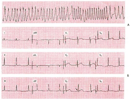 Diagnosticul diferențial al tahicardiei supraventriculare cu aberații și ventriculari