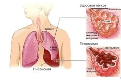 Exerciții respiratorii cu pneumonie