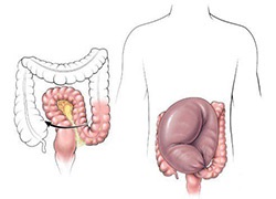 Dolihosigma intestinului la adulți și copii simptome, tratament, dietă