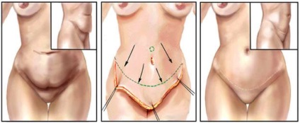 Amețeli ale pielii la nivelul abdomenului - provoacă - prevenirea