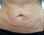 Amețeli ale pielii abdomenului - cauze, simptome, diagnostic și tratament