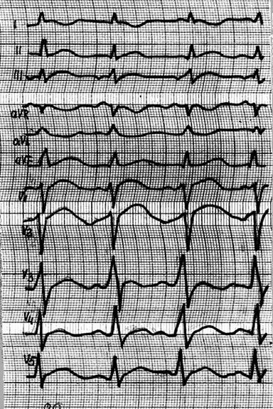 ECG în diagnosticul miocarditei