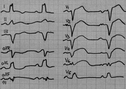 ECG în diagnosticul miocarditei