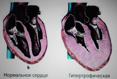 ECG în diagnosticul miocarditei