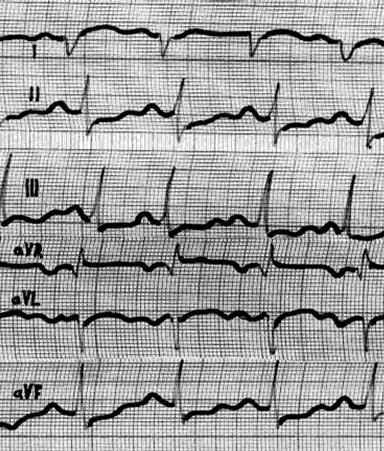 ECG în diagnosticul miocarditei