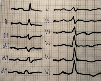 ECG în diagnosticul miocarditei