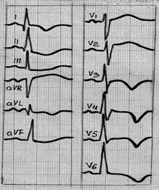 ECG în diagnosticul miocarditei