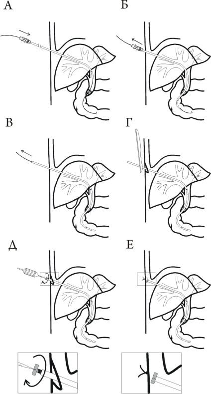 Endoproteticele conductelor biliare