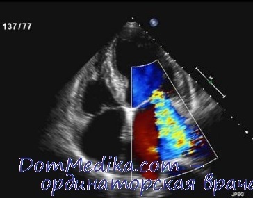 Ecocardiografie cu insuficiență mitrală