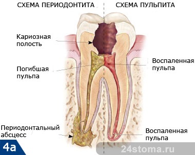 Flux pe gumă cum să se vindece și de ce depinde tratamentul