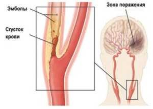 Accident vascular cerebral în partea stângă a efectelor creierului și dacă paralizia este posibilă