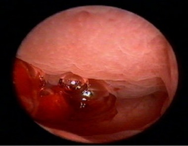 Cum să crească endometrul endometrului în 2 zile