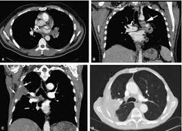 Cum de a determina cancerul pulmonar Acordați atenție simptomelor alarmante, bolii pulmonare