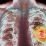 Как да се идентифицират рак на белия дроб, отделят внимание на предупредителните сигнали за белодробни заболявания