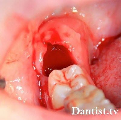 Cum să opriți sângele după îndepărtarea dintelui înțelepciunii 1