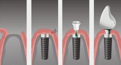 Hogyan működik a fogászati ​​implantáció a fogak beültetésének klasszikus módszere?