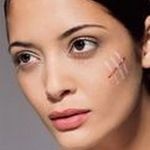 Cum să elimini cicatrici, cicatrici pe pielea feței, cosmetolog profesionist