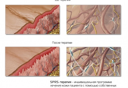 Cum să crească o nouă întinerire a pielii cu terapie spros-terapie