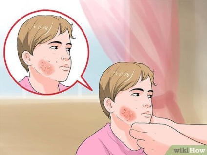 Cum să trăiești cu herpes zoster