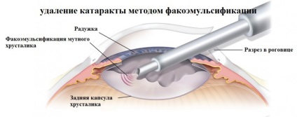 Cataracta cauze, simptome, tratament si prevenirea bolilor