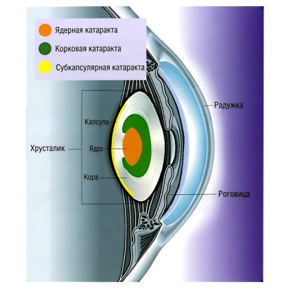 Cataracta cauze, simptome, tratament si prevenirea bolilor