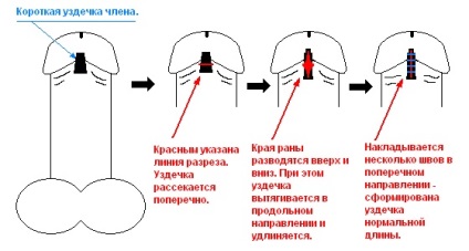 Sindromul preputului de scurtă durată la bărbați (frenulotomie) și chirurgie