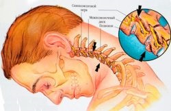 Tratamentul și prevenirea osteocondrozei de lagăr