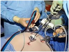 Laparoscopia tuburilor uterine după perioada de operație, magnetoterapie, dietă, stimulare - articole,