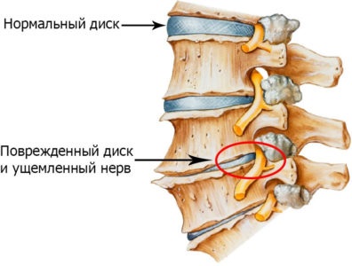 Exerciții fizico-terapeutice pentru osteocondroza cervicală