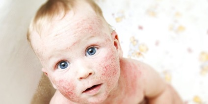 Tratamentul dermatitei atopice la un copil sau adult cu remedii folclorice, unguente și creme