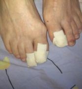 Tratamentul ciupercii unghiilor la picioare cu remedii populare la domiciliu metode, metode, rețete