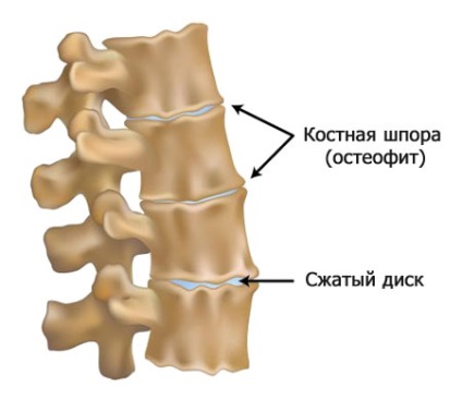 La o osteochondroză a unui departament de col uterin din cele mai bune 2 complexe (o fotografie, video)