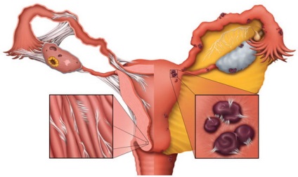 Az endometriózis gyógyszeres kezelése, mely készítményeket választanak, hogyan kell kezelni