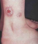 Monedă (numeroasă) fotografie eczemă, simptome, cauze, tratament